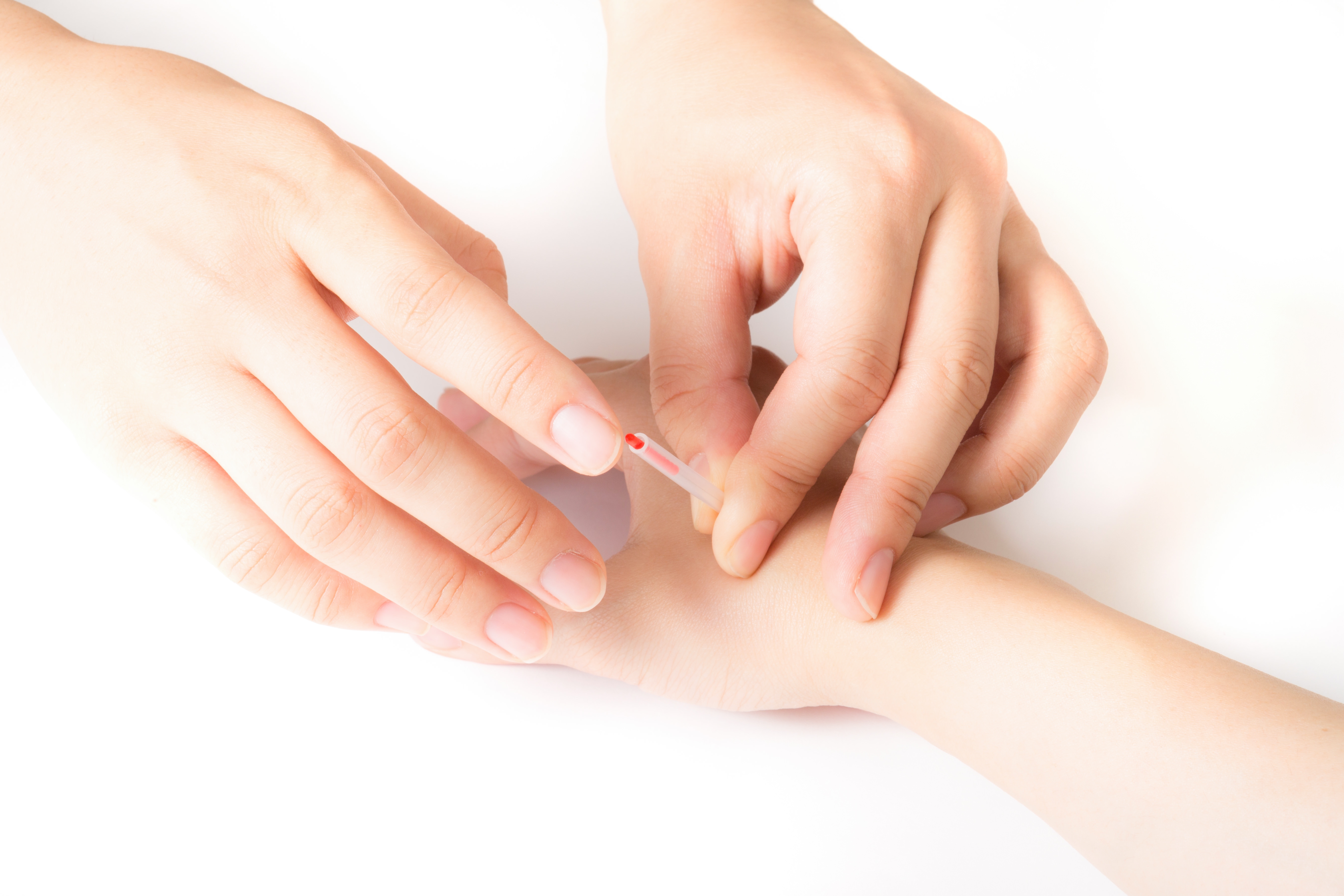 手のツボに鍼を刺す様子